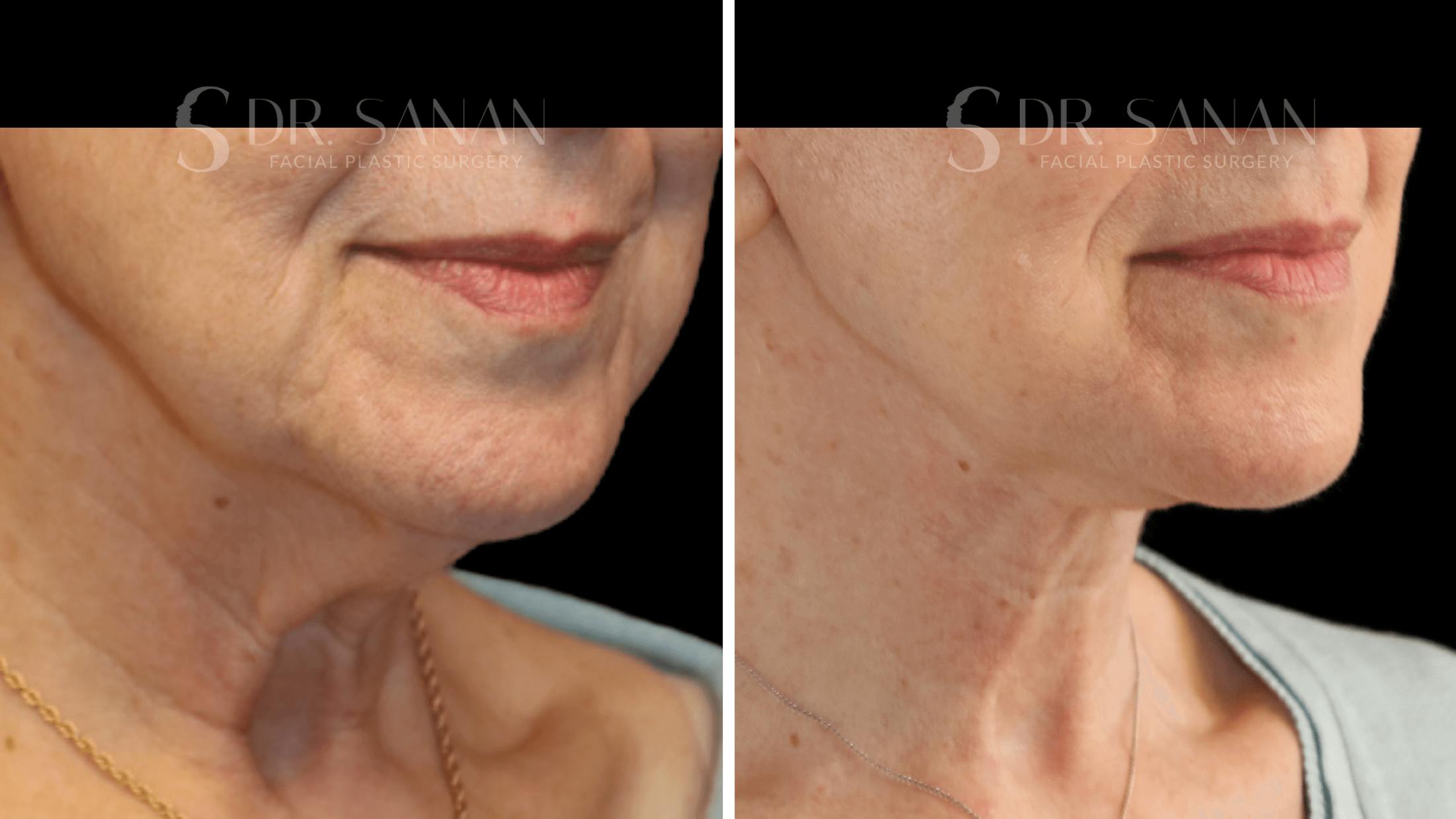 Neck Lift Before & After Gallery - Patient 276137 - Image 2