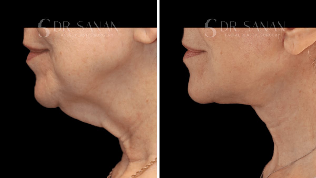 Neck Lift Before & After Gallery - Patient 276137 - Image 6