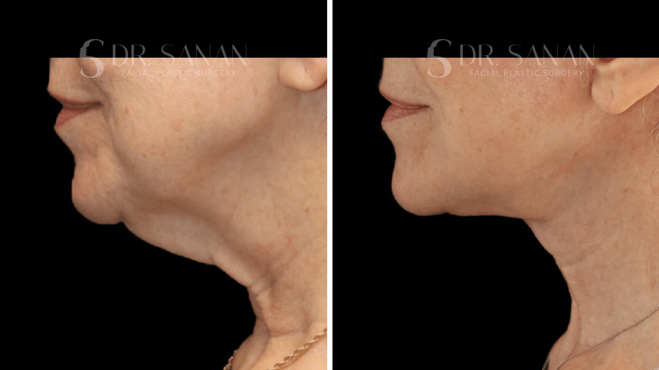 Neck Lift Before & After Gallery - Patient 276137 - Image 6