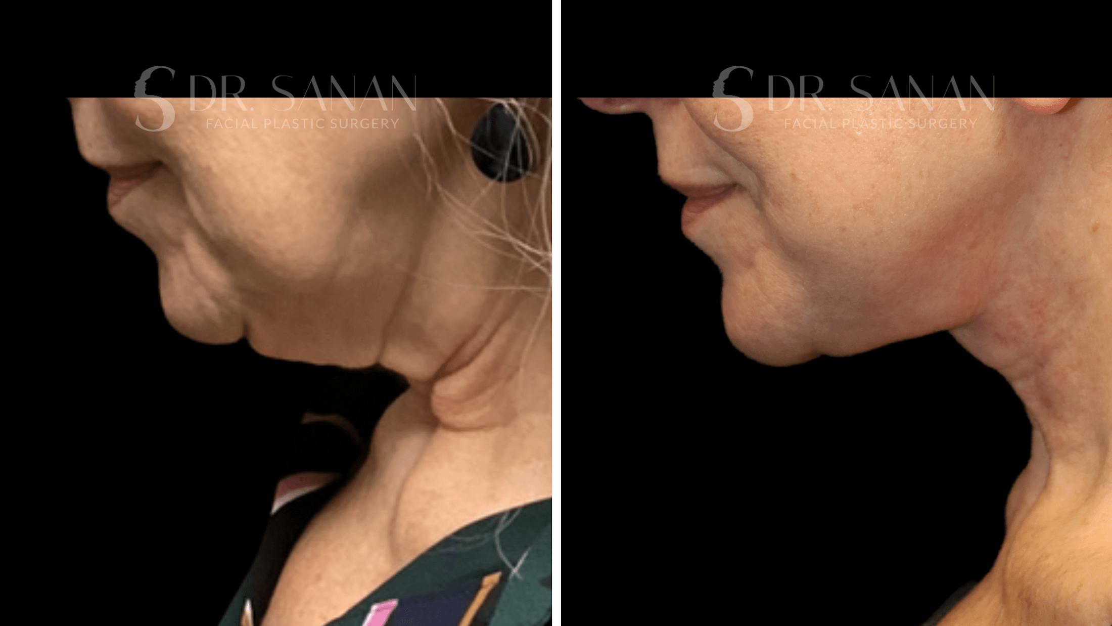Neck Lift Before & After Gallery - Patient 276137 - Image 7