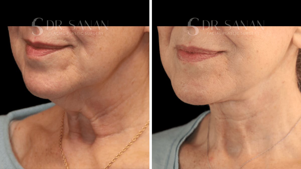 Neck Lift Before & After Gallery - Patient 276137 - Image 5