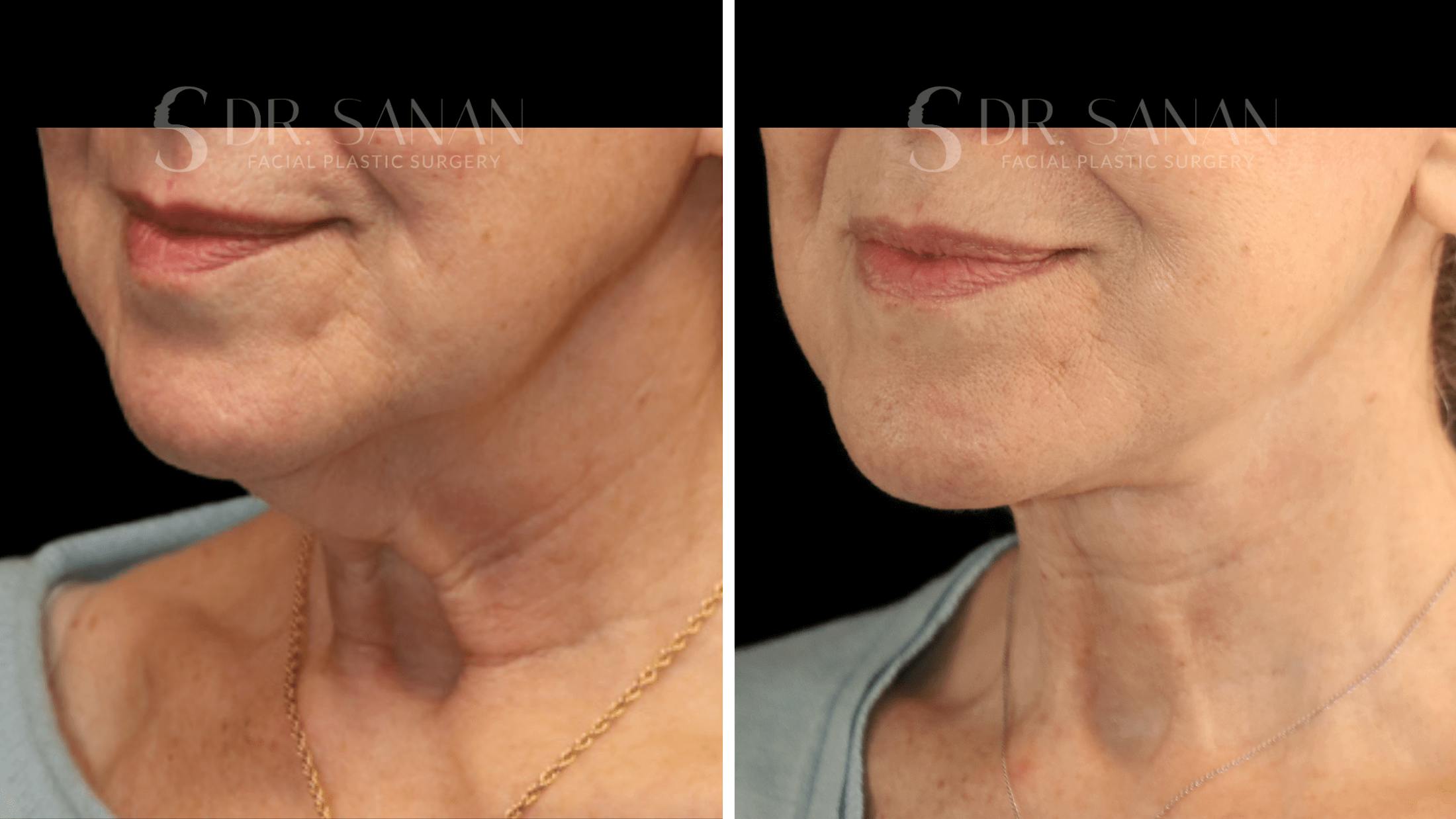 Neck Lift Before & After Gallery - Patient 276137 - Image 5