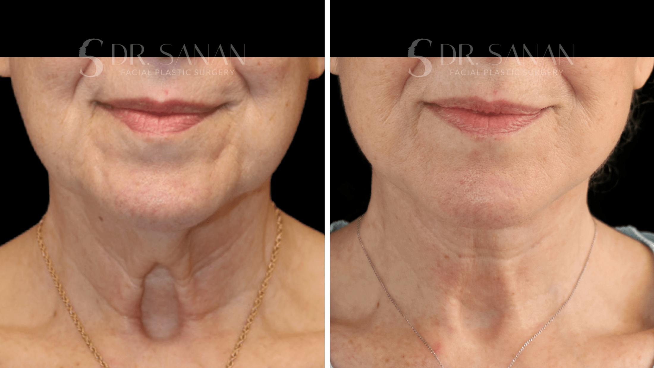 Neck Lift Before & After Gallery - Patient 276137 - Image 1