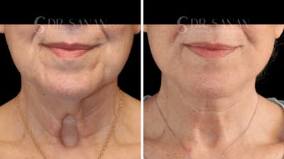 Neck Lift Before & After Gallery - Patient 276137 - Image 1
