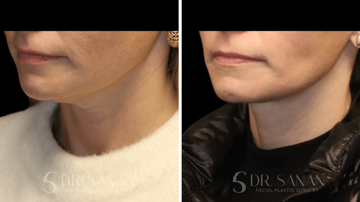 Neck Lift Before & After Gallery - Patient 116273 - Image 2