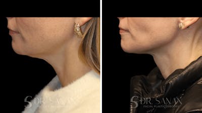 Neck Lift Before & After Gallery - Patient 116273 - Image 1
