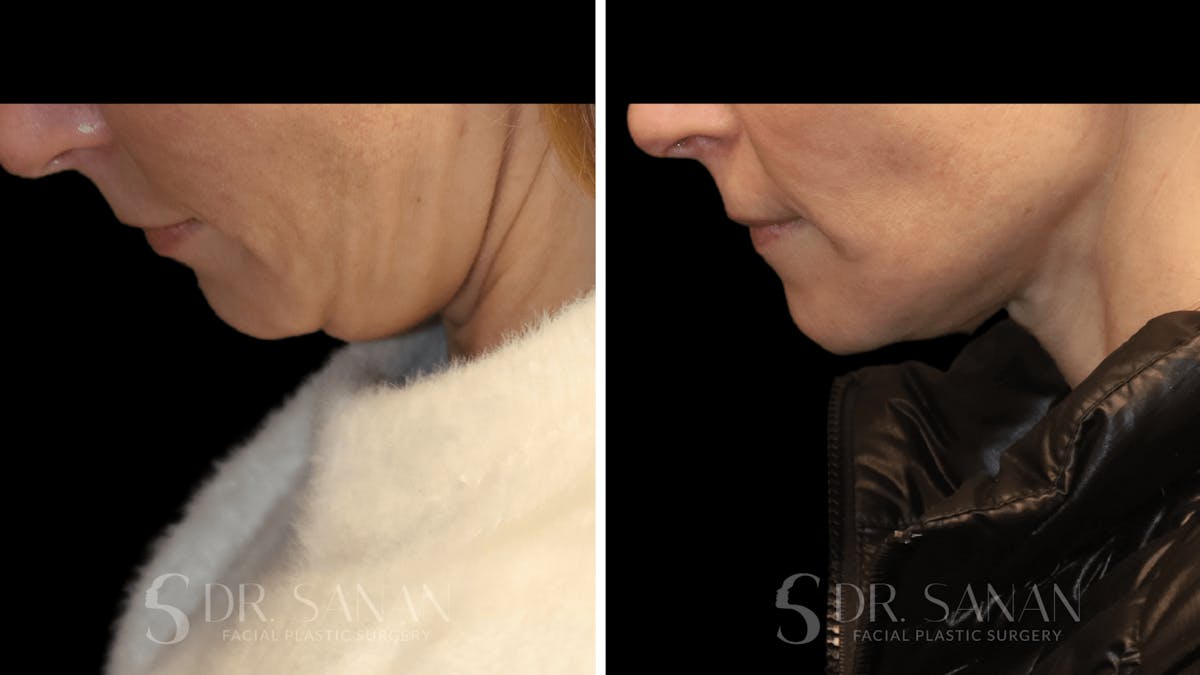Neck Lift Before & After Gallery - Patient 116273 - Image 4
