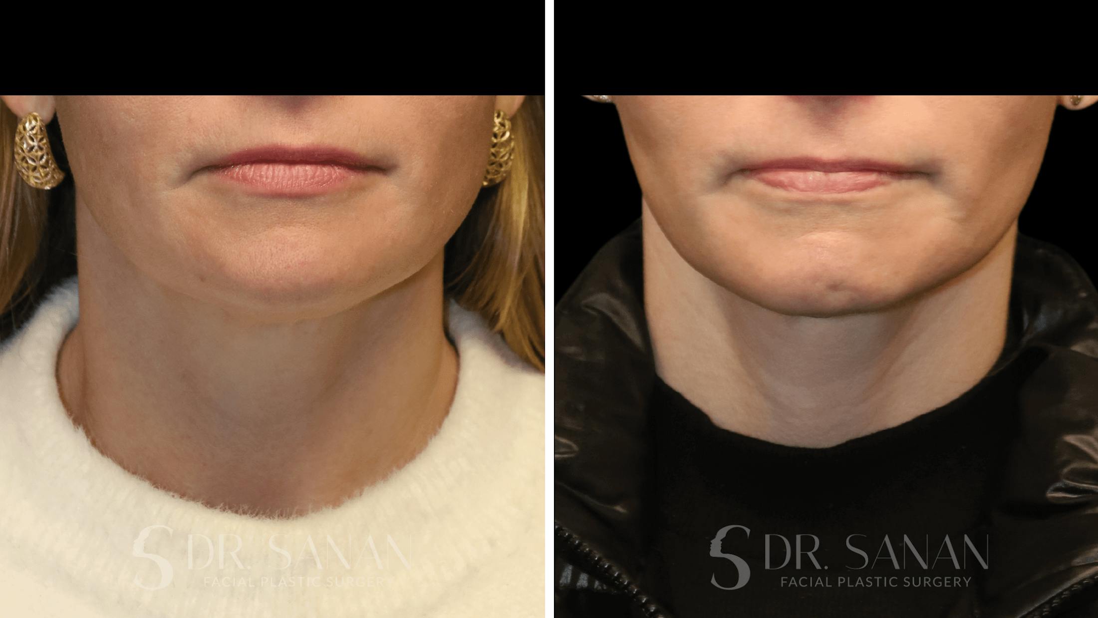 Neck Lift Before & After Gallery - Patient 116273 - Image 1