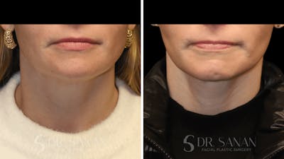 Neck Lift Before & After Gallery - Patient 116273 - Image 1