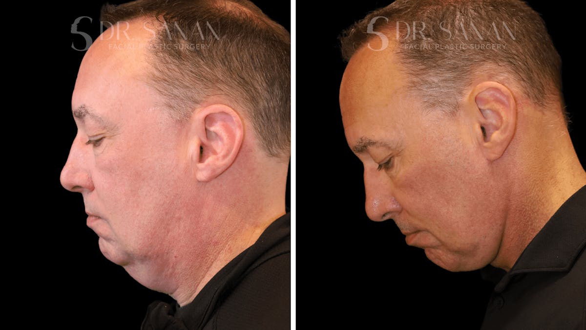 Neck Lift Before & After Gallery - Patient 419258 - Image 7