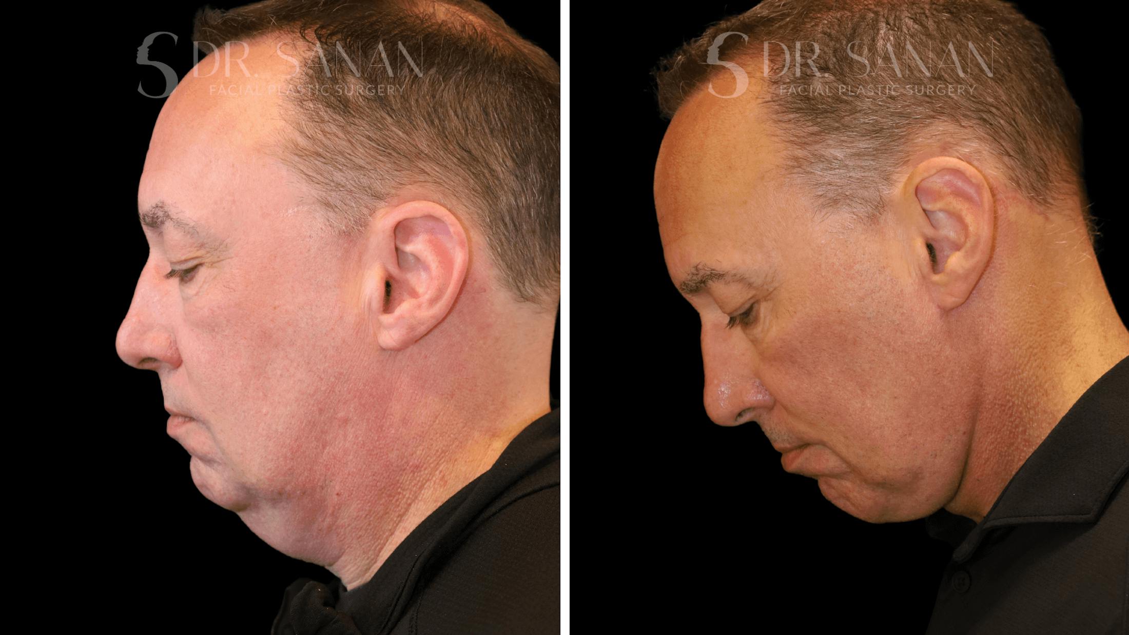 Neck Lift Before & After Gallery - Patient 419258 - Image 7