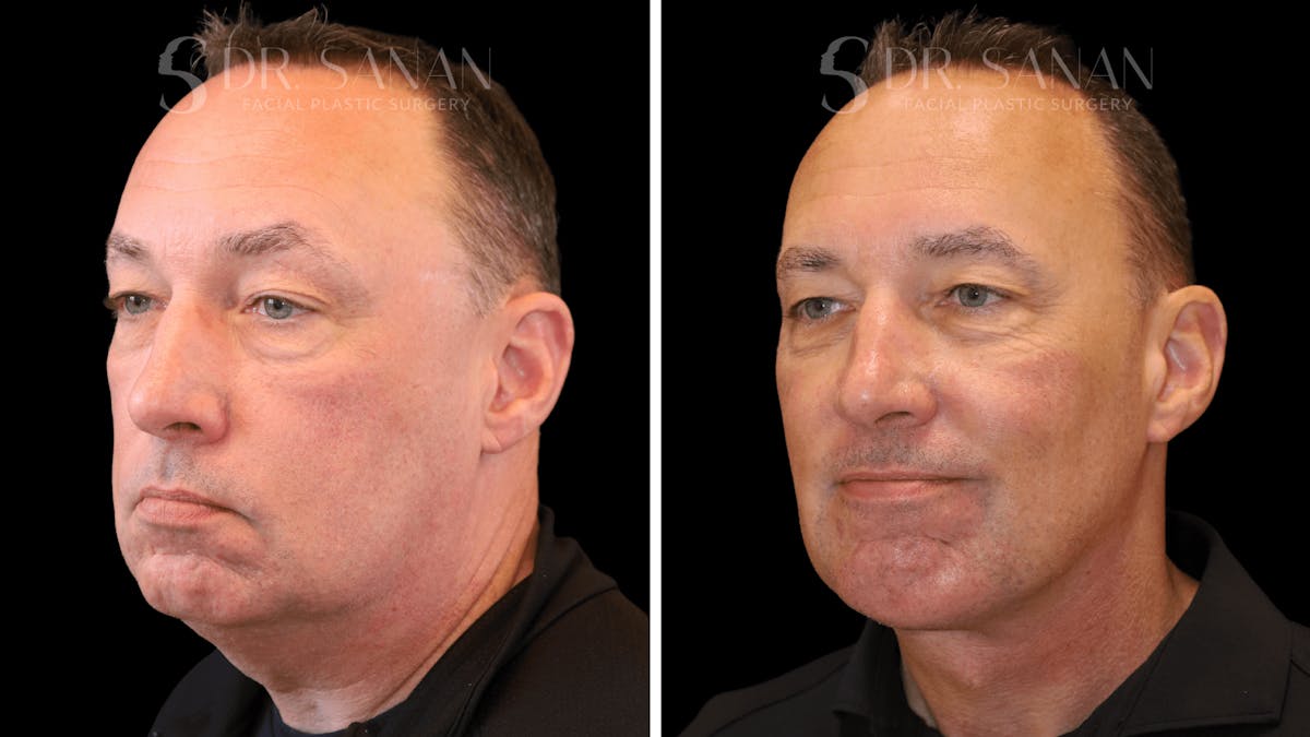 Neck Lift Before & After Gallery - Patient 419258 - Image 5