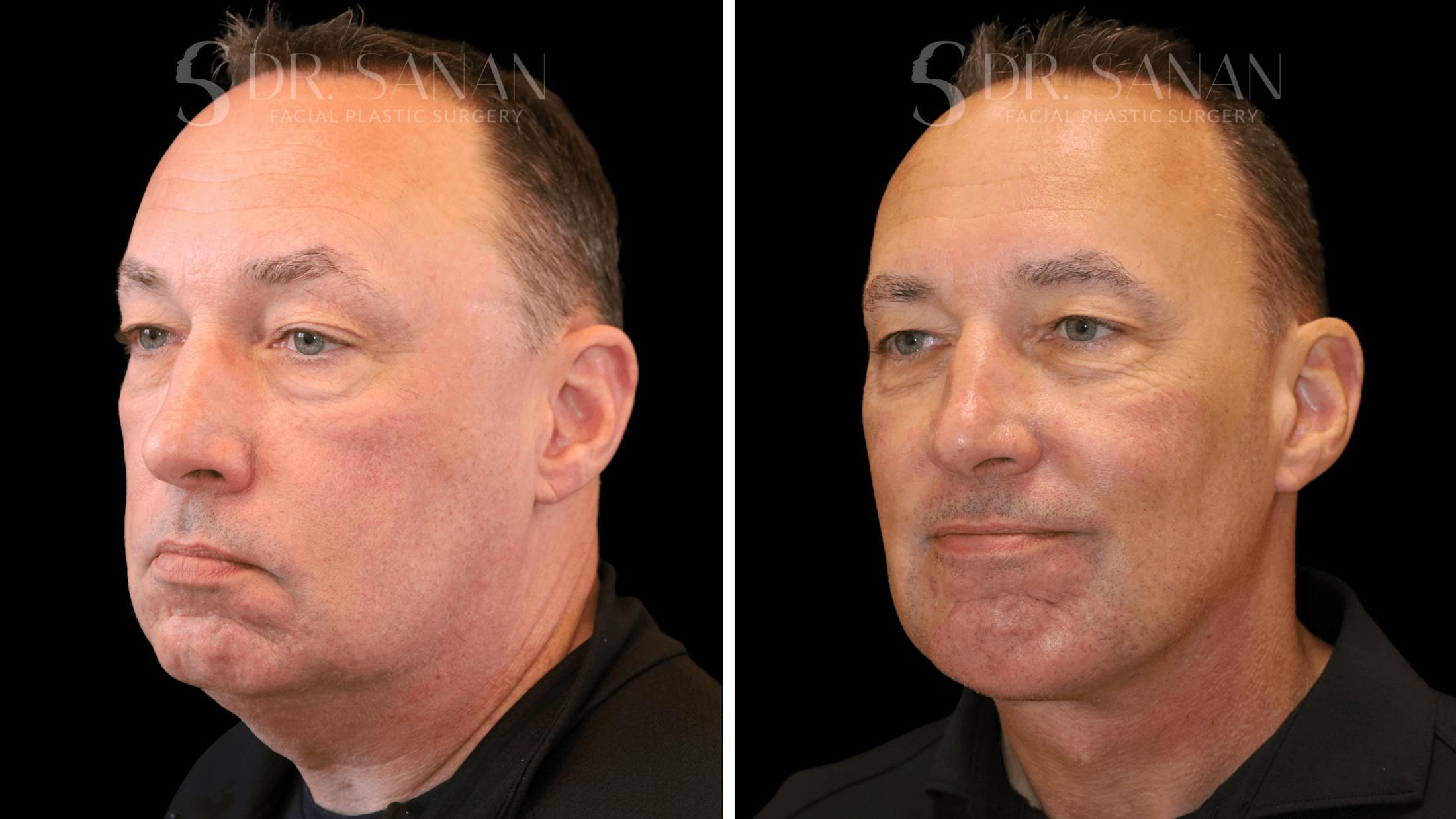 Neck Lift Before & After Gallery - Patient 419258 - Image 5