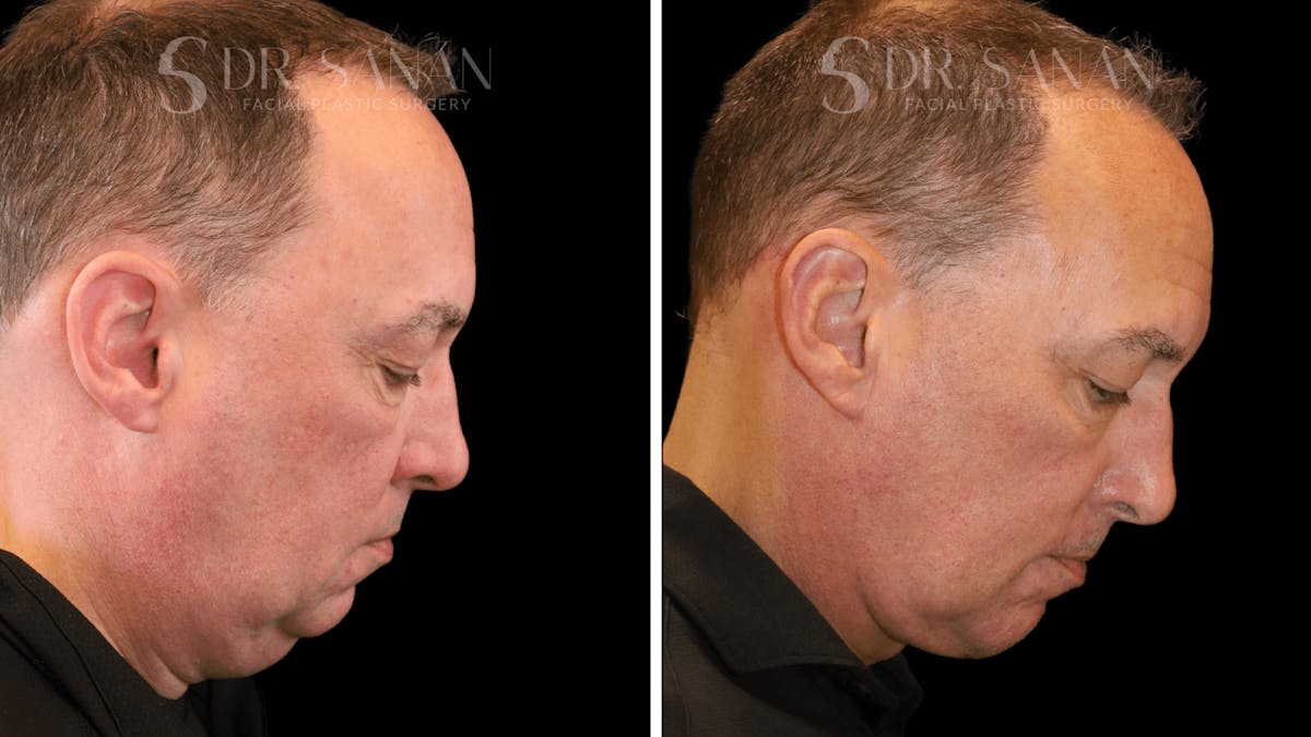 Neck Lift Before & After Gallery - Patient 419258 - Image 4