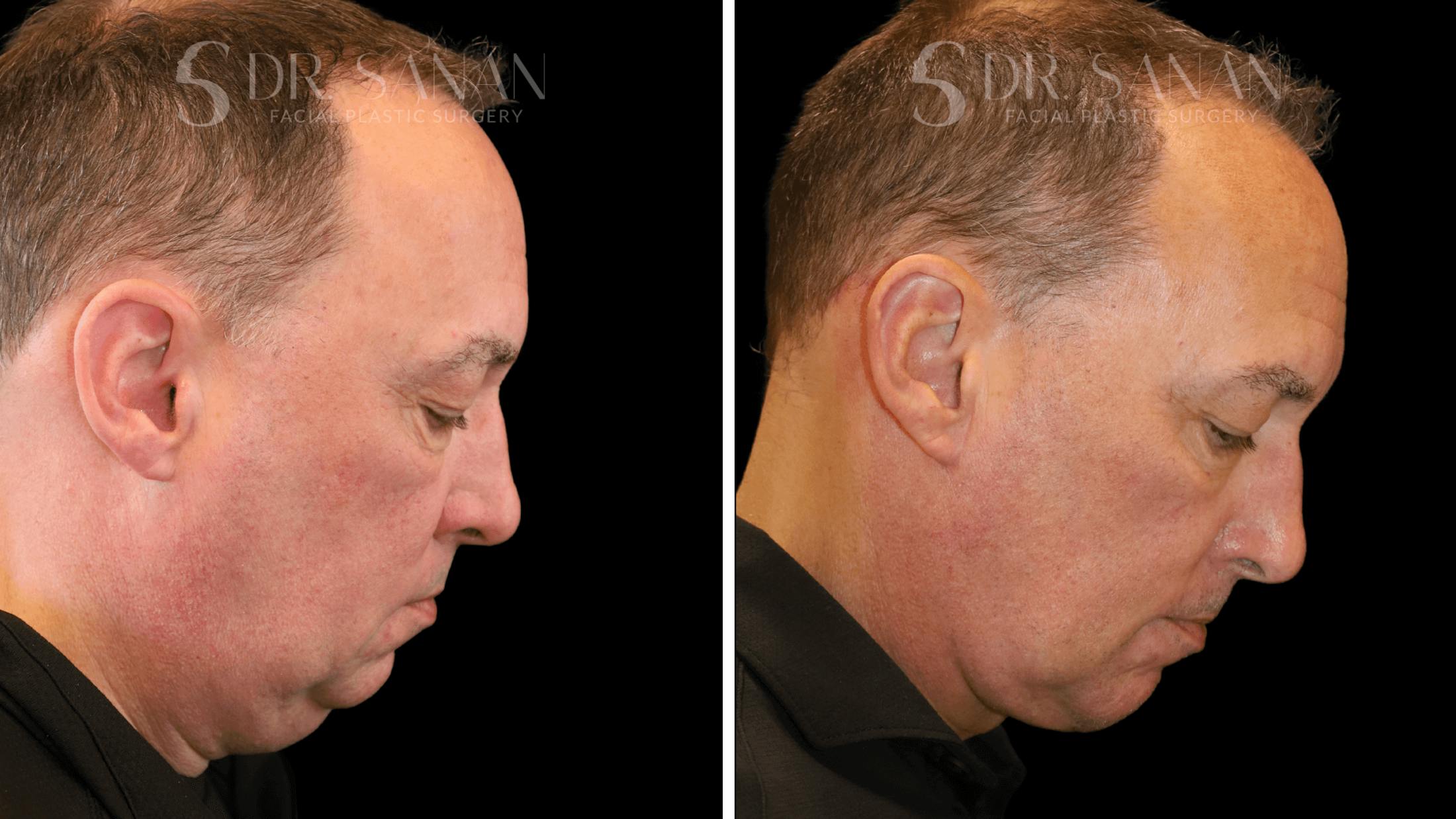 Neck Lift Before & After Gallery - Patient 419258 - Image 4