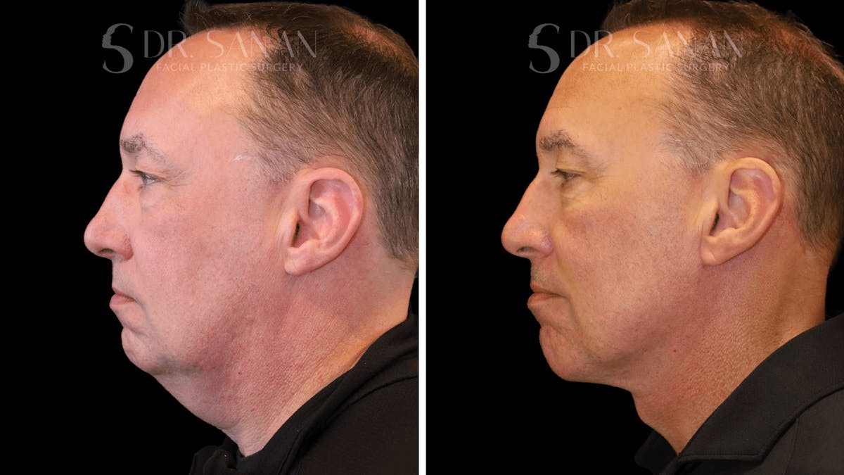 Neck Lift Before & After Gallery - Patient 419258 - Image 6