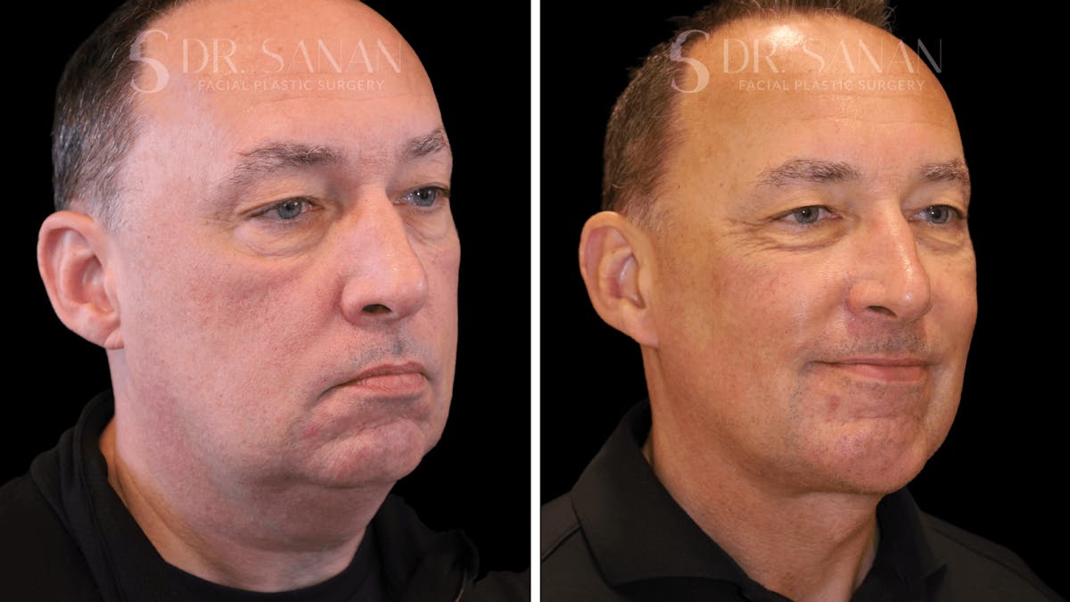 Neck Lift Before & After Gallery - Patient 419258 - Image 2