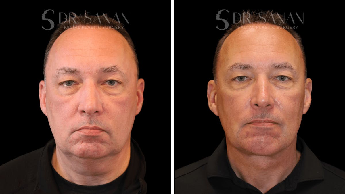 Neck Lift Before & After Gallery - Patient 419258 - Image 1