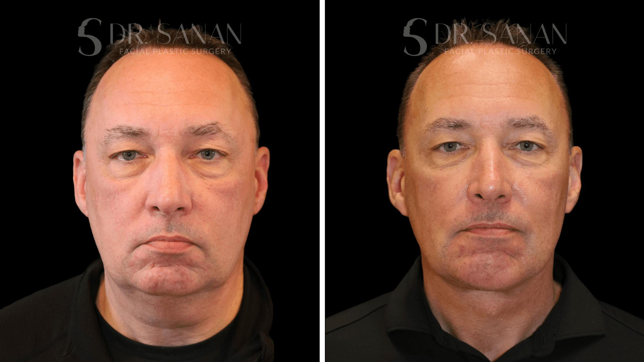 Neck Lift Before & After Gallery - Patient 419258 - Image 1