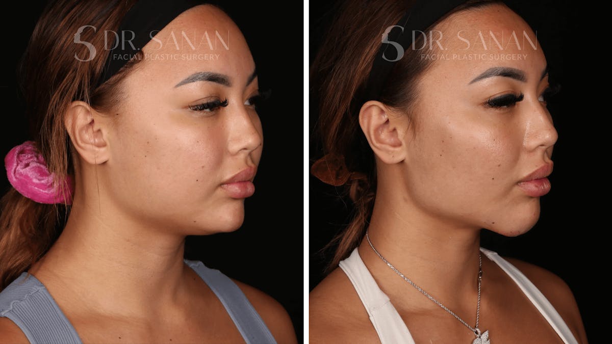 Neck Lift Before & After Gallery - Patient 121603 - Image 2