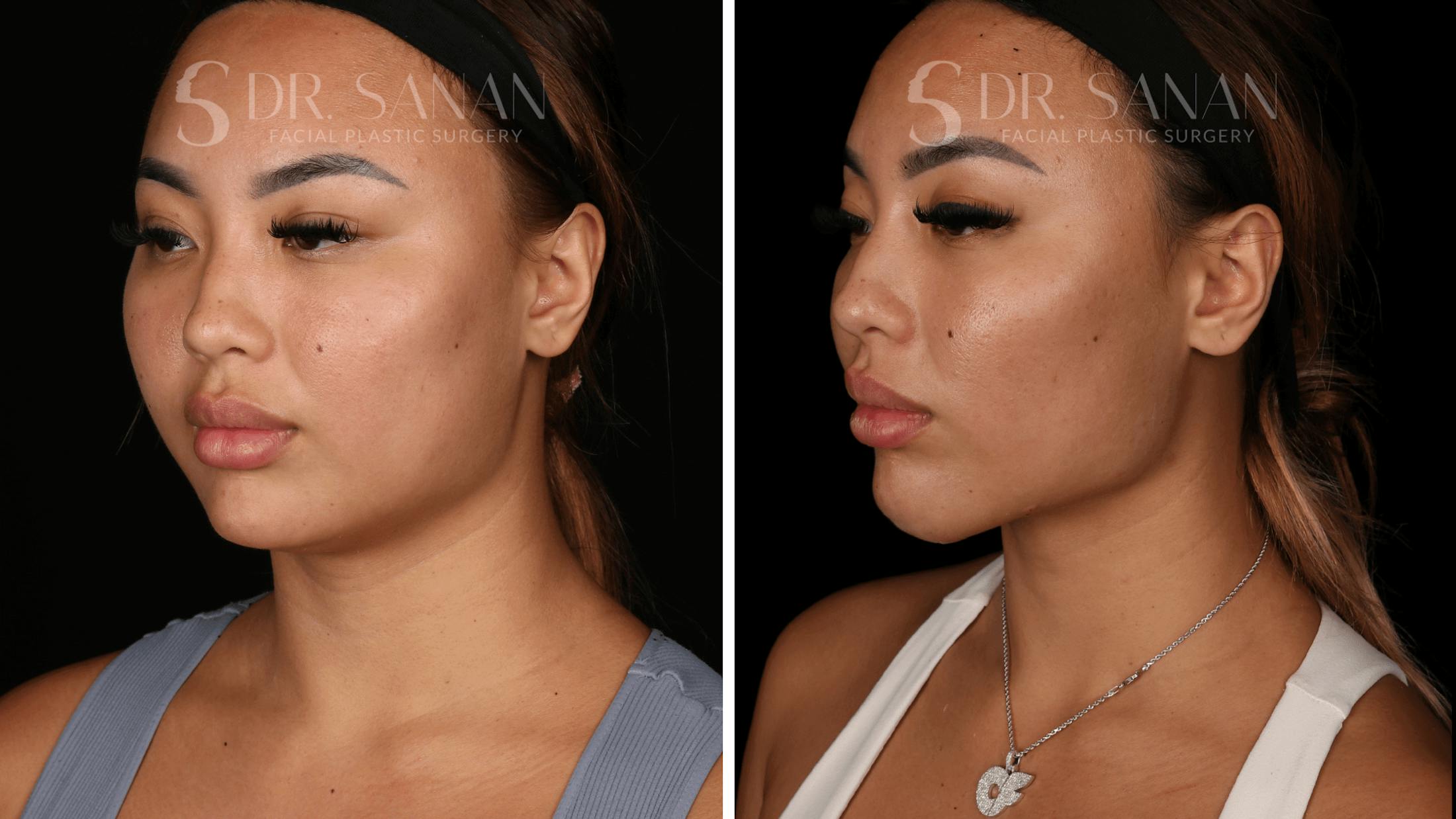 Neck Lift Before & After Gallery - Patient 121603 - Image 5