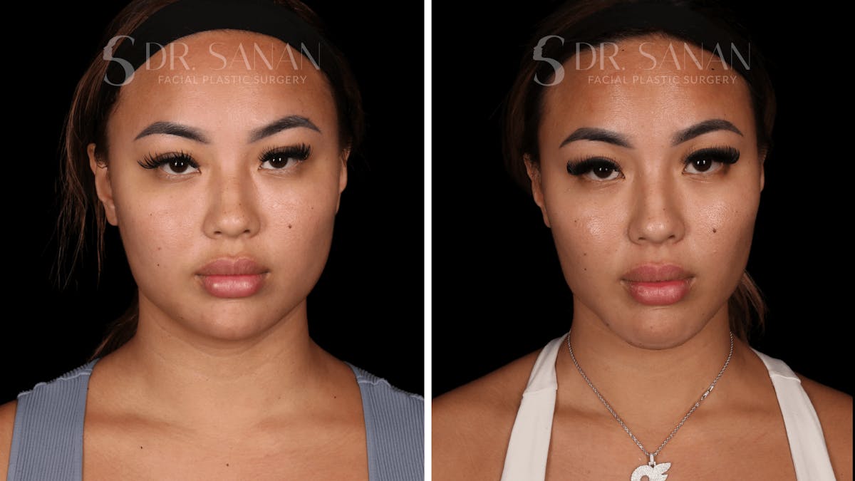 Neck Lift Before & After Gallery - Patient 121603 - Image 1