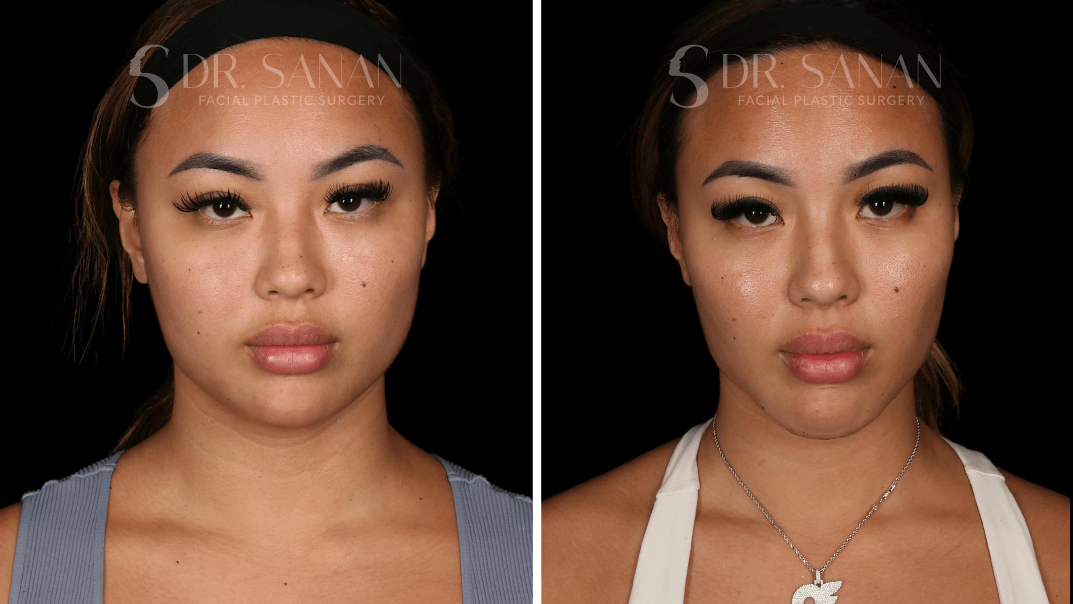 Neck Lift Before & After Gallery - Patient 121603 - Image 1