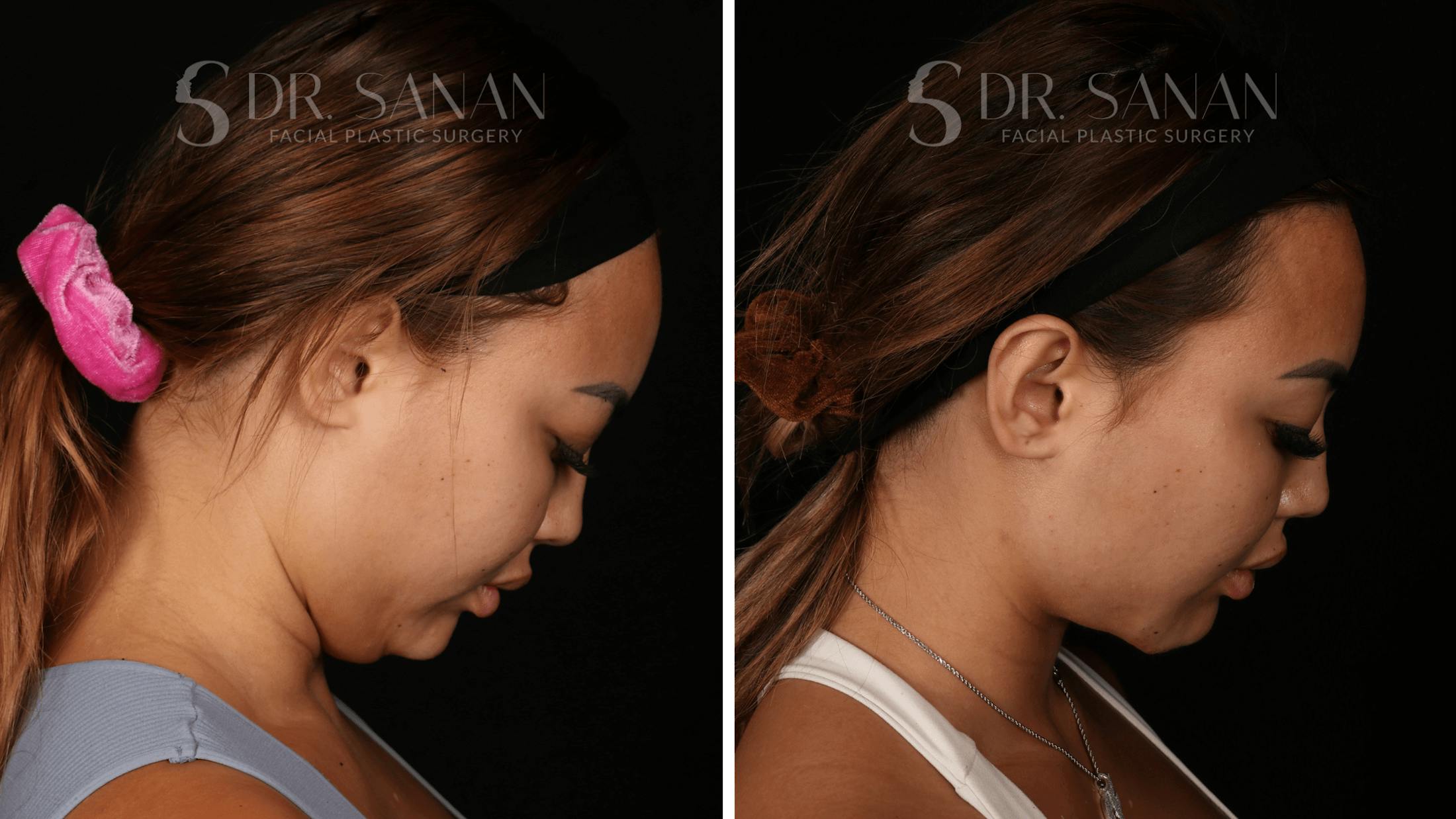 Neck Lift Before & After Gallery - Patient 121603 - Image 4