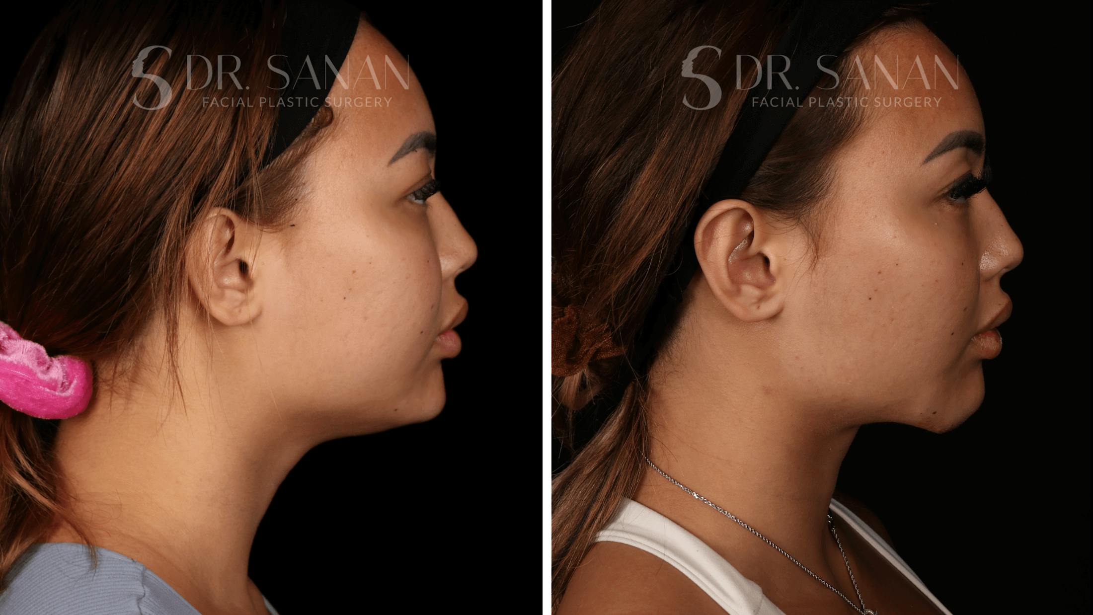 Neck Lift Before & After Gallery - Patient 121603 - Image 3