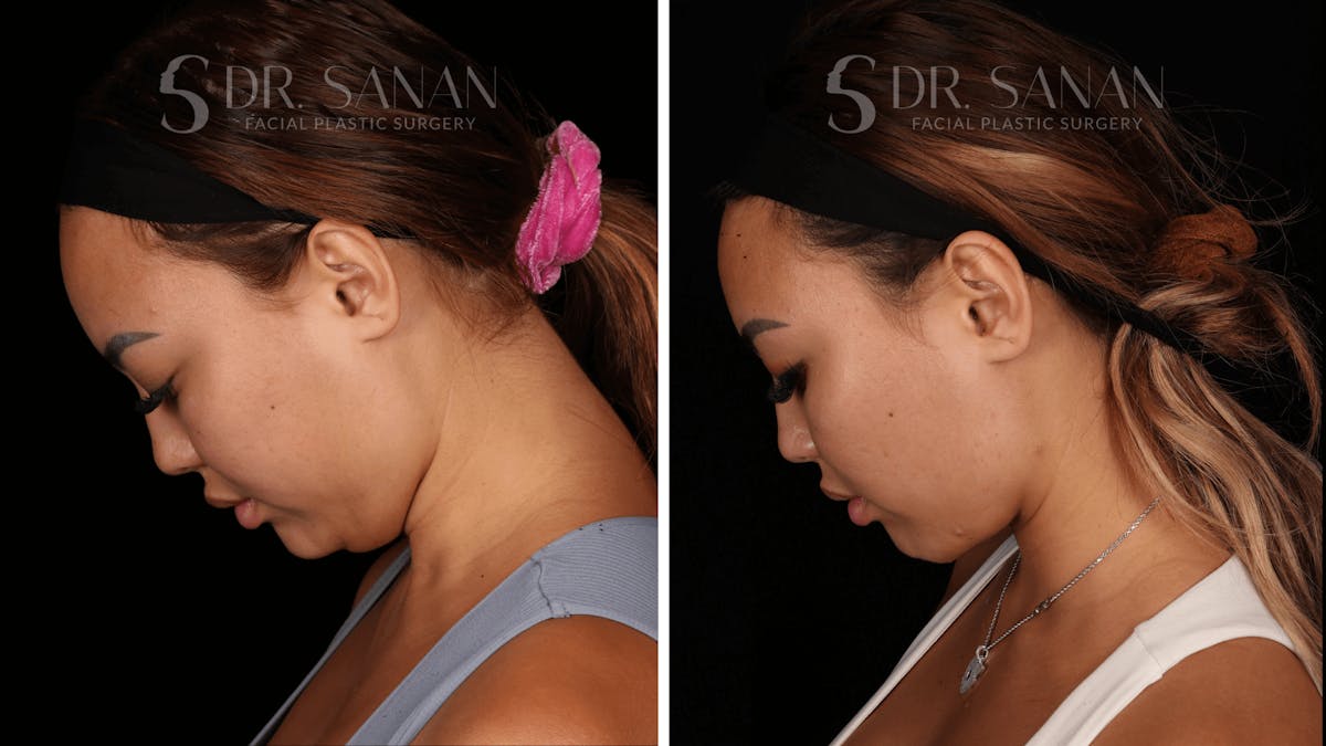 Neck Lift Before & After Gallery - Patient 121603 - Image 7