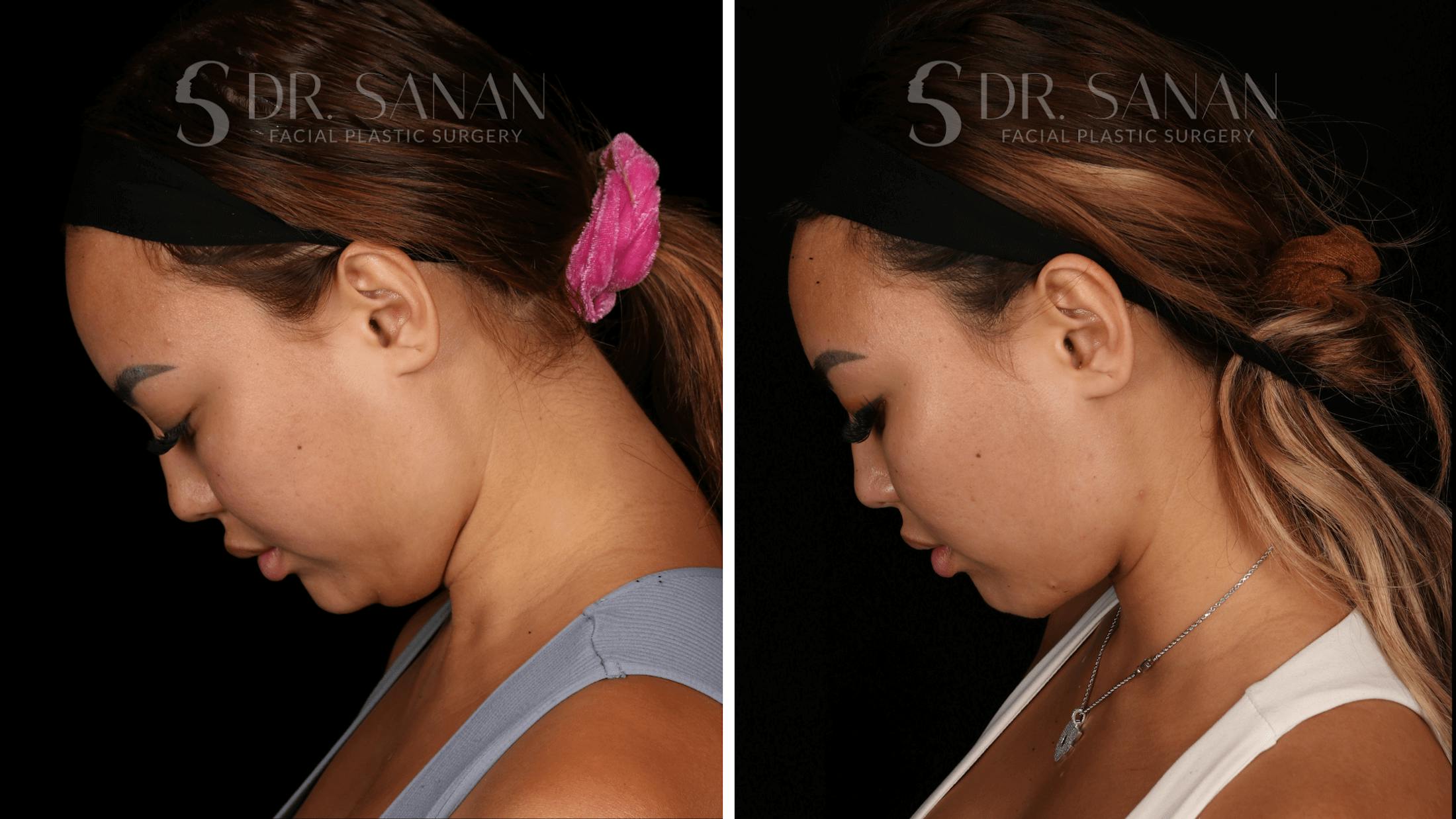 Neck Lift Before & After Gallery - Patient 121603 - Image 7