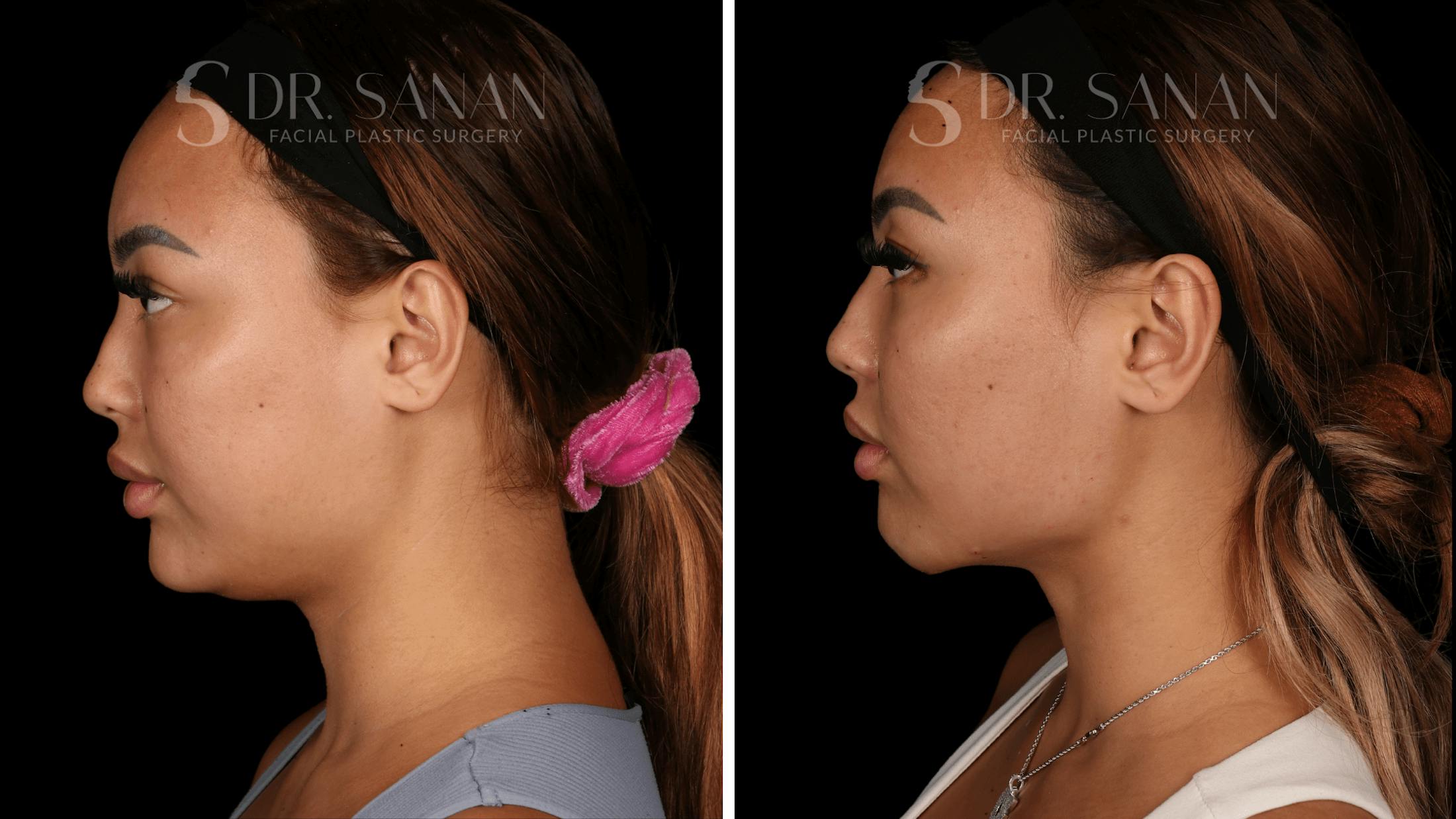Neck Lift Before & After Gallery - Patient 121603 - Image 6
