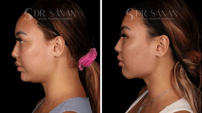 Chin Augmentation Before & After Gallery - Patient 163930 - Image 1