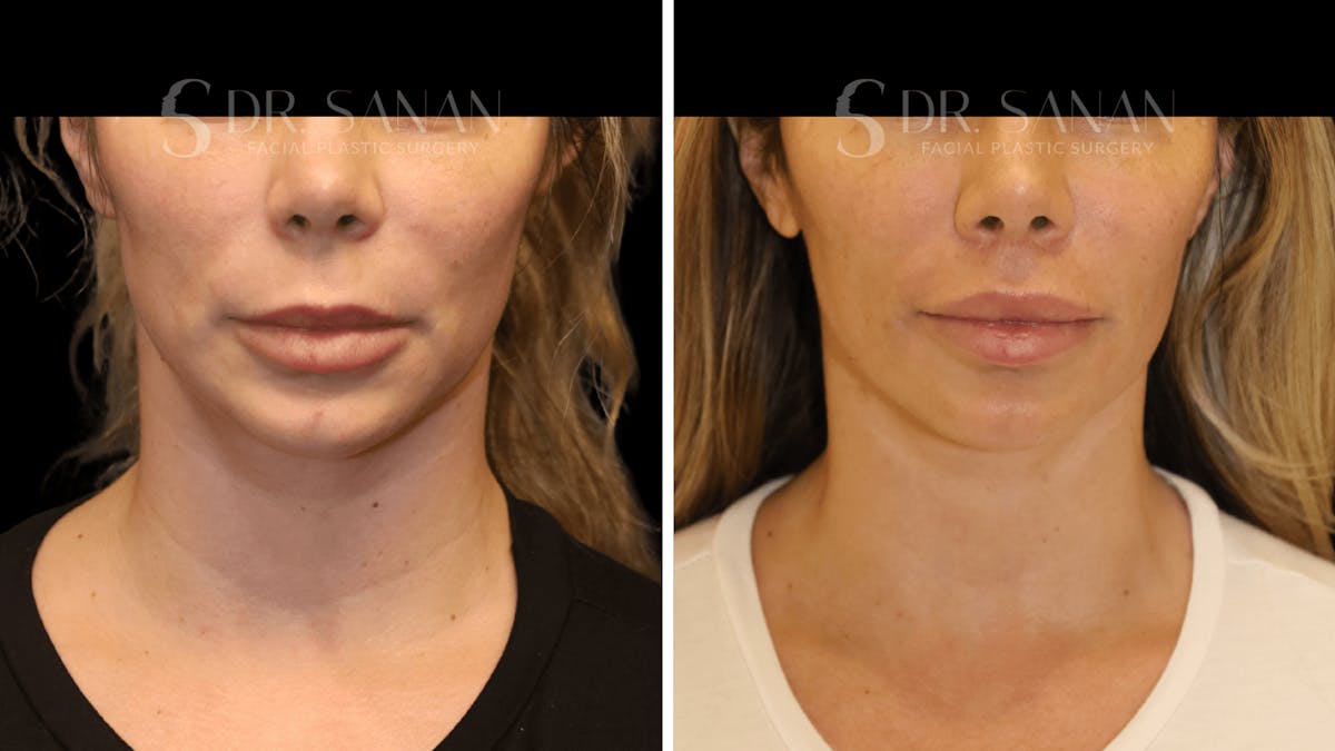 Lip Lift Before & After Gallery - Patient 346531 - Image 1