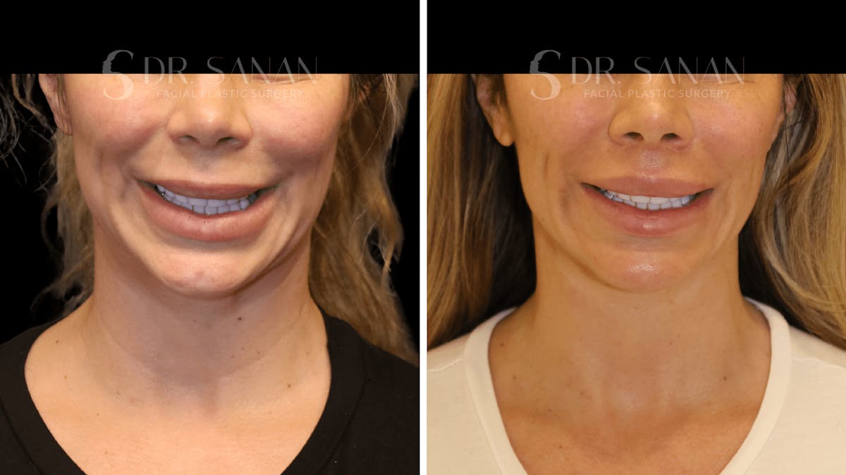 Lip Lift Before & After Gallery - Patient 346531 - Image 2