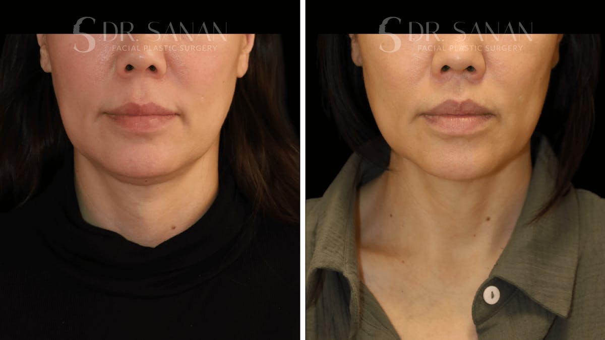 Lip Lift Before & After Gallery - Patient 161221 - Image 1