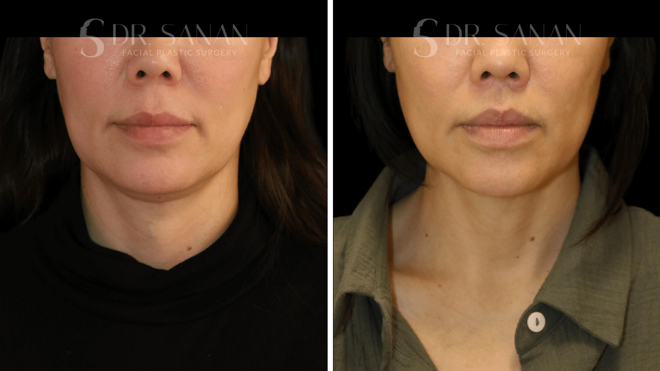 Lip Lift Before & After Gallery - Patient 161221 - Image 1