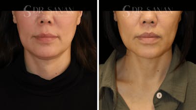 Lip Lift Before & After Gallery - Patient 161221 - Image 1