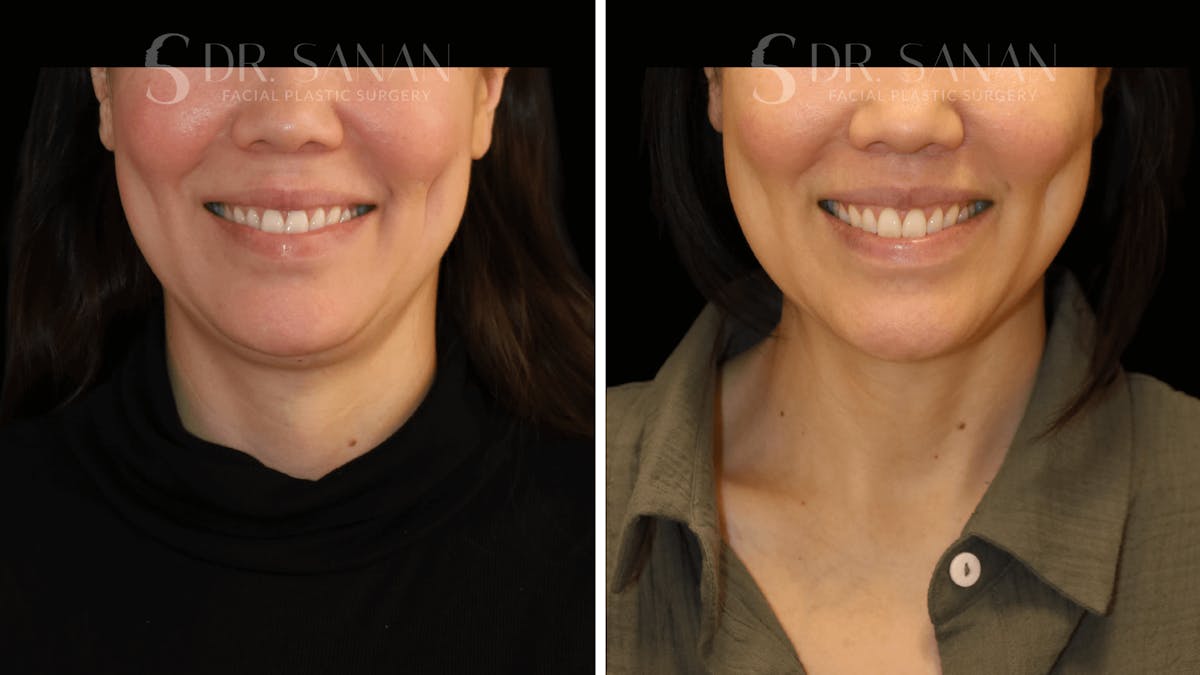 Lip Lift Before & After Gallery - Patient 161221 - Image 3