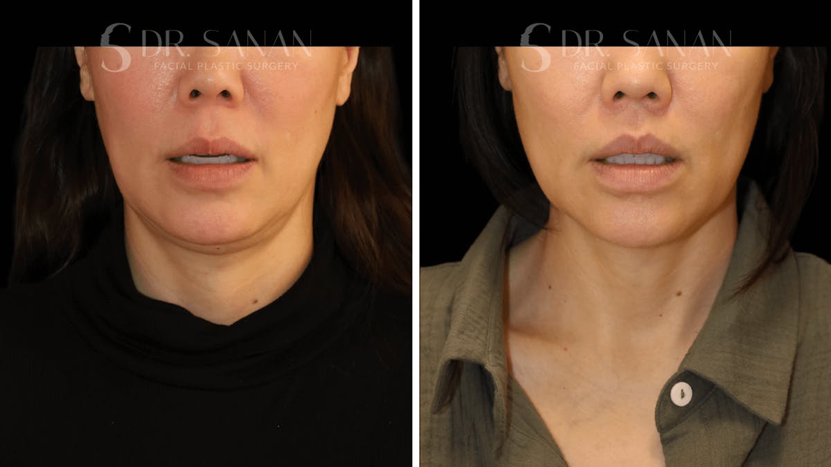 Lip Lift Before & After Gallery - Patient 161221 - Image 2