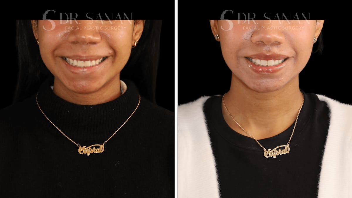 Lip Lift Before & After Gallery - Patient 361414 - Image 3