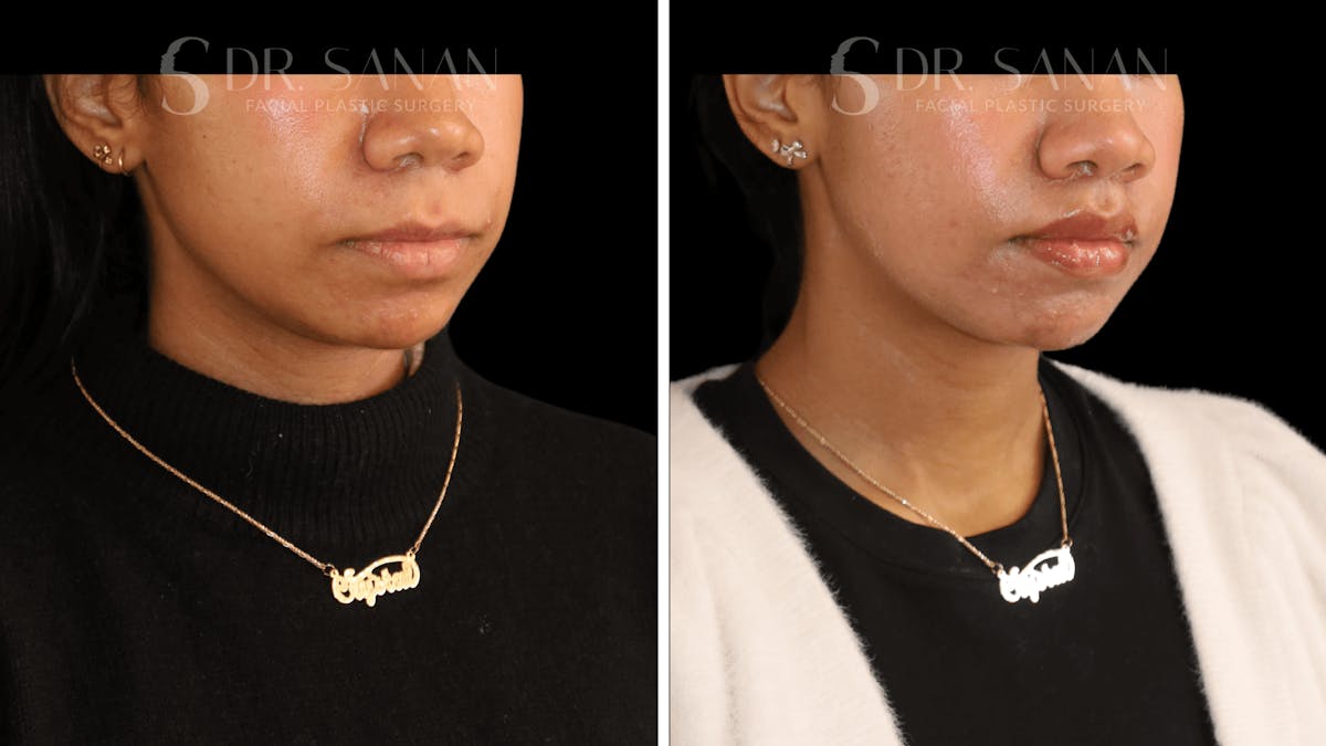 Lip Lift Before & After Gallery - Patient 361414 - Image 4