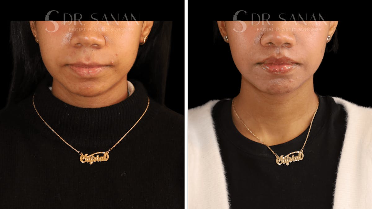 Lip Lift Before & After Gallery - Patient 361414 - Image 1