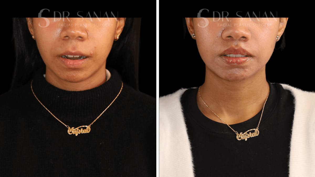 Lip Lift Before & After Gallery - Patient 361414 - Image 2