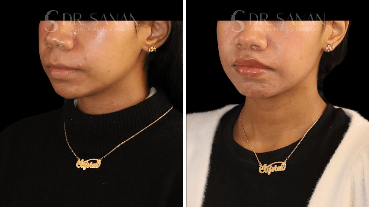 Lip Lift Before & After Gallery - Patient 361414 - Image 5