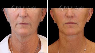 Lip Lift Before & After Gallery - Patient 609917 - Image 1