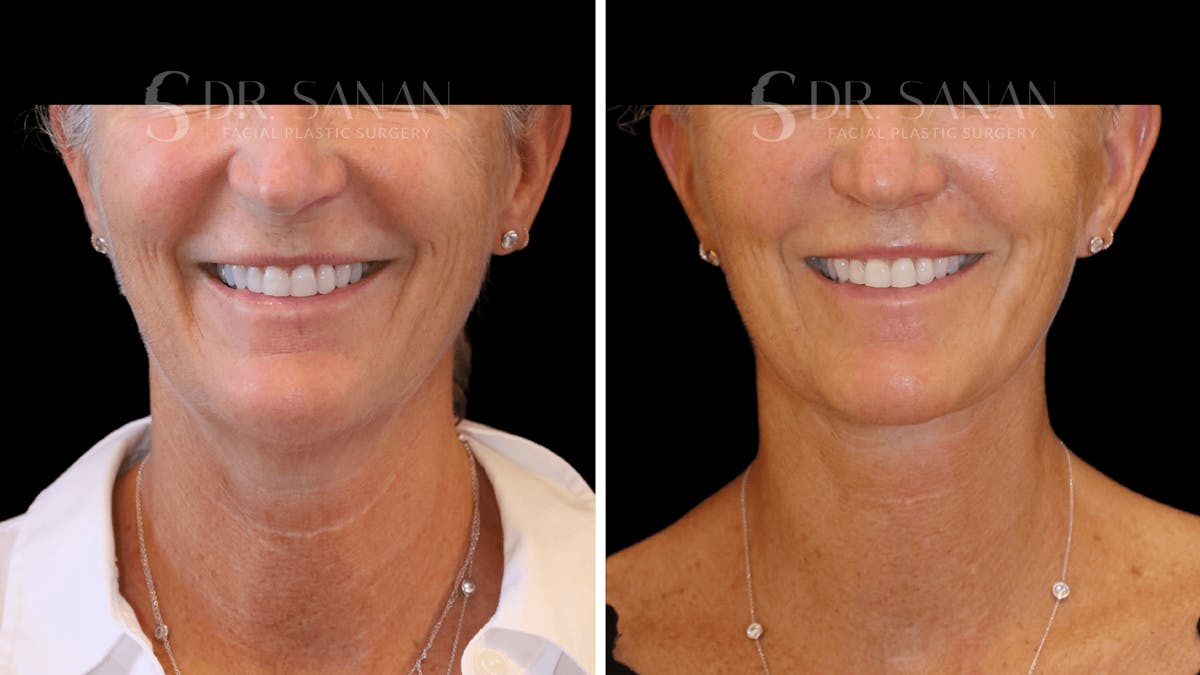 Lip Lift Before & After Gallery - Patient 609917 - Image 2