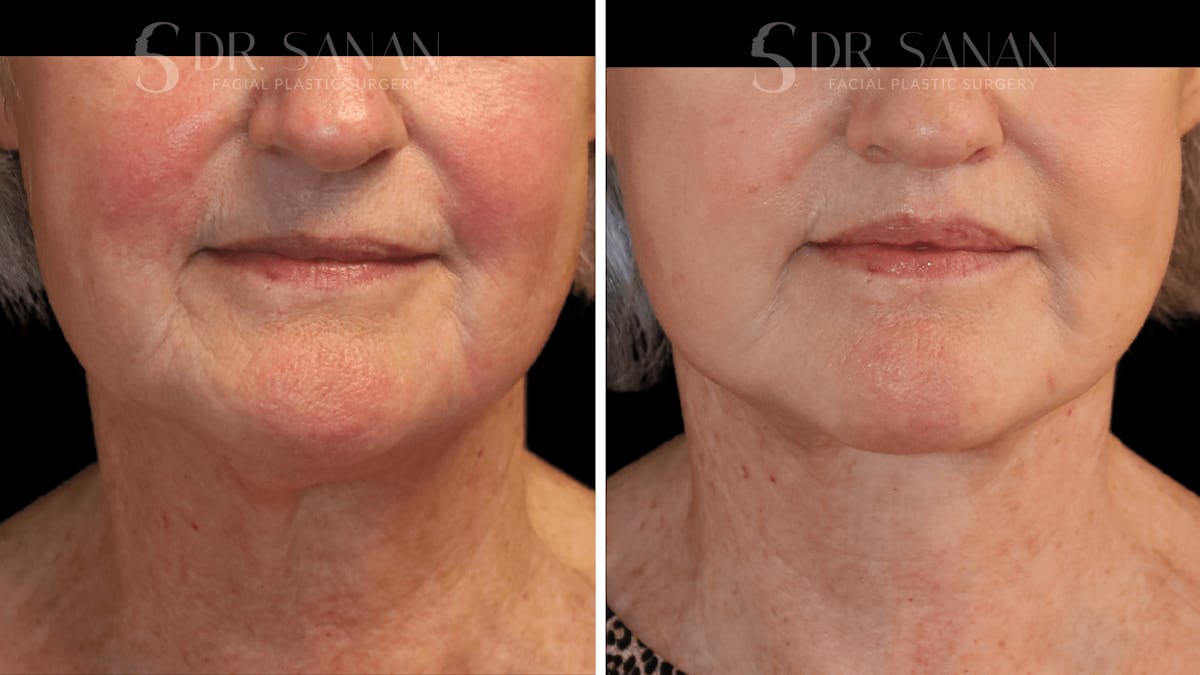 Lip Lift Before & After Gallery - Patient 249703 - Image 1
