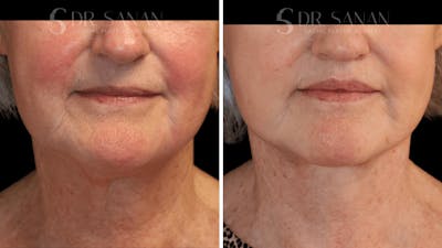 Lip Lift Before & After Gallery - Patient 249703 - Image 1