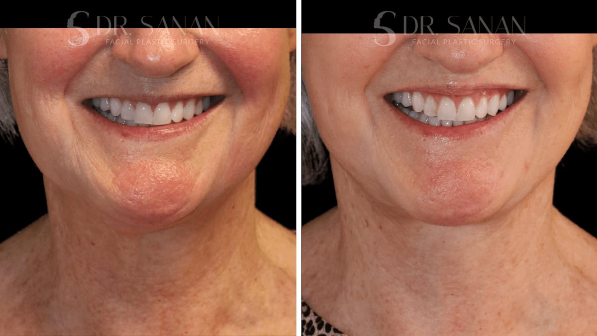 Lip Lift Before & After Gallery - Patient 249703 - Image 2